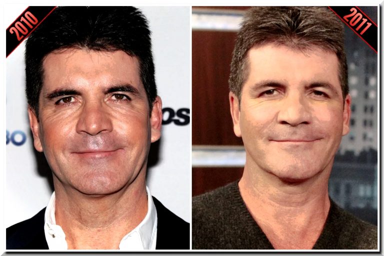 Simon Cowell Admit to Use Botox Injection but Rejects to Undergo ...